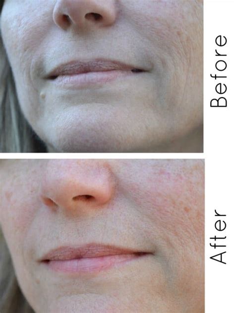 roc retinol cream before and after results.